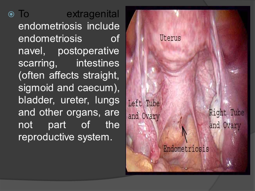 To extragenital endometriosis include endometriosis of navel, postoperative scarring, intestines (often affects straight, sigmoid